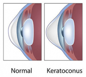 illustration of Keratoconus in the eye
